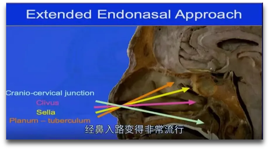 冰球运动员重返赛场！治疗颅咽管瘤，国际上有了新方法，不开颅成优选？