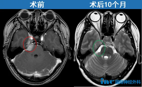 桥小脑角（CPA）区脑膜瘤