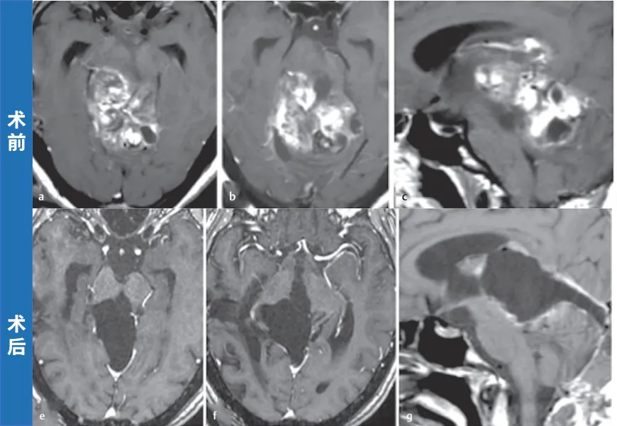 毛细胞型星形细胞瘤（WHOⅠ级）
