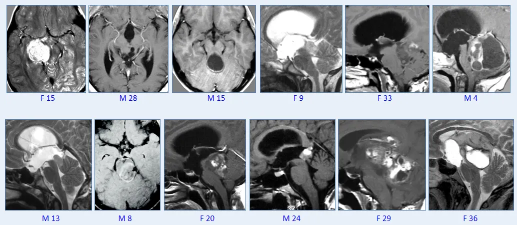 巴教授脑干毛星50+例影像图汇