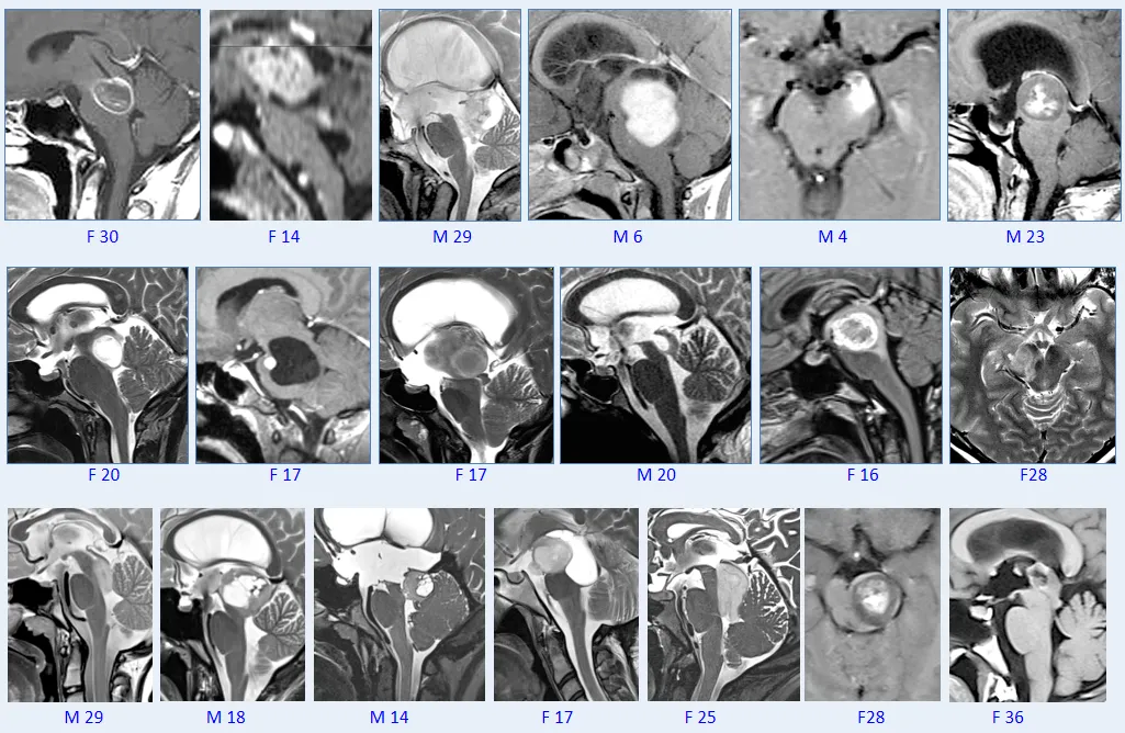 巴教授脑干毛星50+例影像图汇