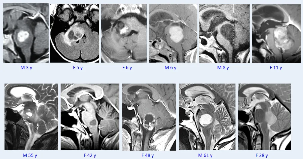 巴教授脑干毛星50+例影像图汇