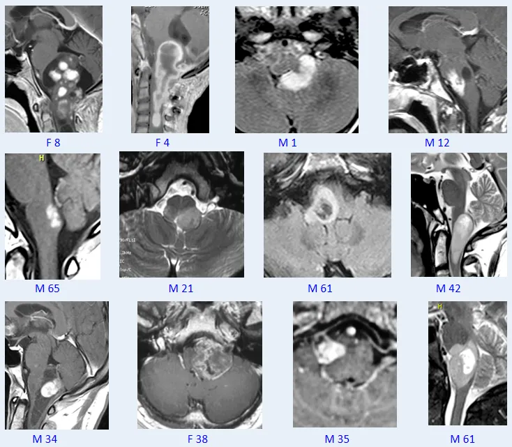 巴教授脑干毛星50+例影像图汇