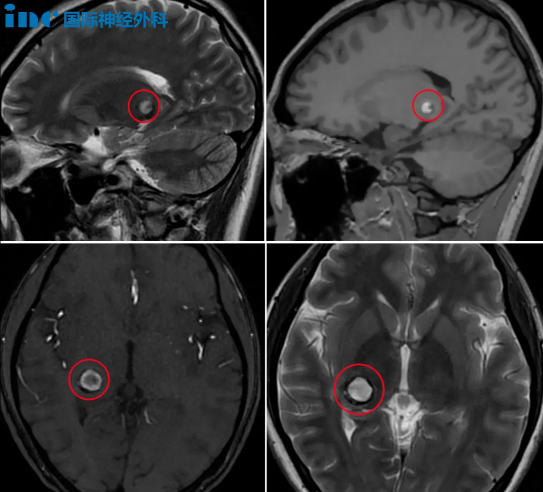 右侧丘脑海绵状血管瘤
