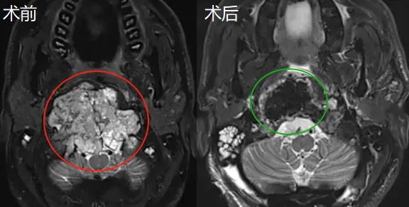 03显微镜+神经内镜：成功全切肿瘤