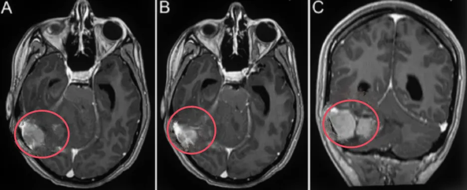 13岁那年，我差点因脑袋里 “鸡蛋大” 的恶性肿瘤丢掉小命！