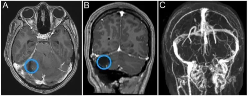 术后影像显示右侧横窦有一个小的残余肿瘤。C显示右侧横窦局灶性血流缺损。