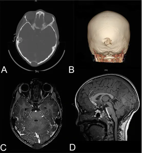 孩子脑袋莫名长肿块，开颅才知是罕见脑瘤，他术后1天即出院！