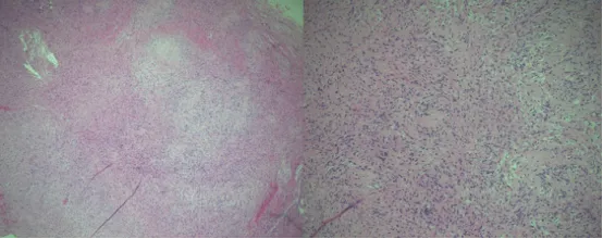 全切术后，孩子恢复良好