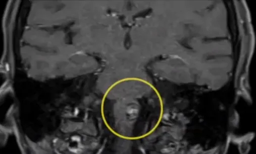 延髓海绵状血管瘤