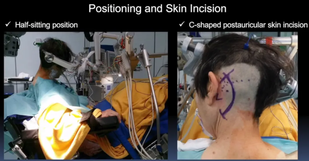 病变全切  　　她从残疾到无症状