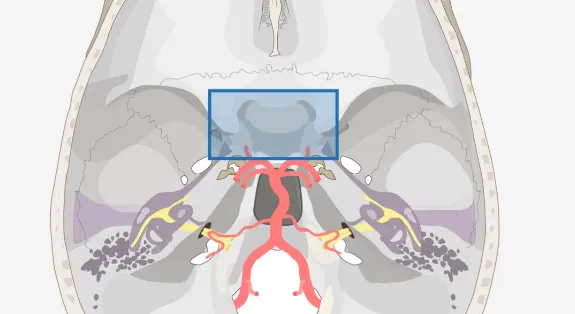 当脑瘤同时遇上“血供丰富”和“紧密粘连”——这凶险的情况，该怎么办？