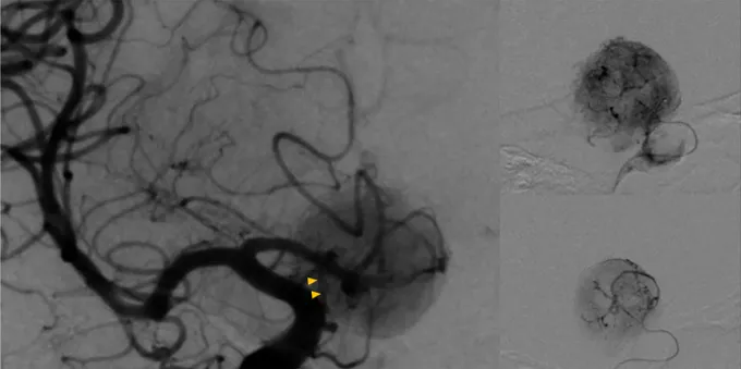 手术难点2：肿瘤血供丰富，术中出血难以控制
