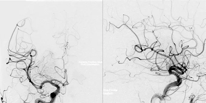 手术难点2：肿瘤血供丰富，术中出血难以控制
