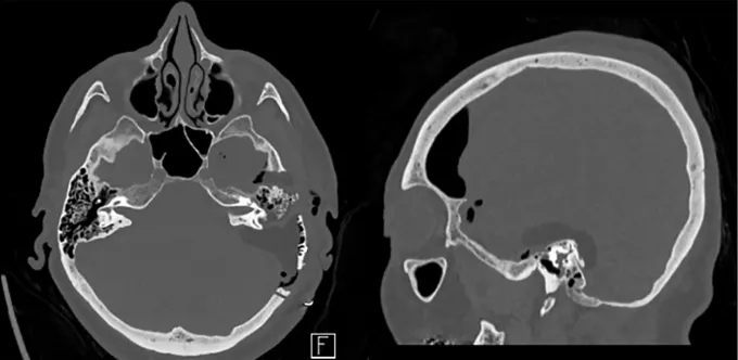 成功安全切除肿瘤