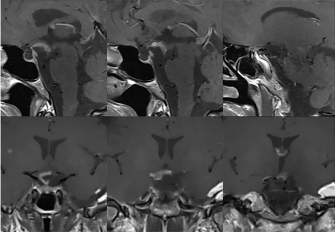 成功安全切除肿瘤