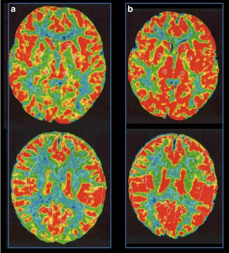 术前Xe-CT显示静息状态无偏侧（a），注射丹木斯（Diamox）后右侧MCA区域脑血管反应性为14.8%（b）。