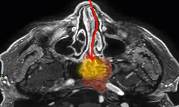 脑瘤手术难道就不能两全其美？