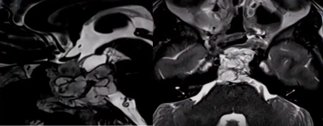 借助角度镜的广阔视野、成角器械的灵活操控，以及内镜医生那双极其灵巧而技术精湛的手，经鼻内镜手术正不断带来惊喜。