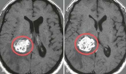 查出肾癌又遭脑瘤打击，是转移瘤还是原发？手术还是放疗？