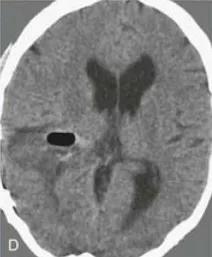 术后CT证实无残留（D）
