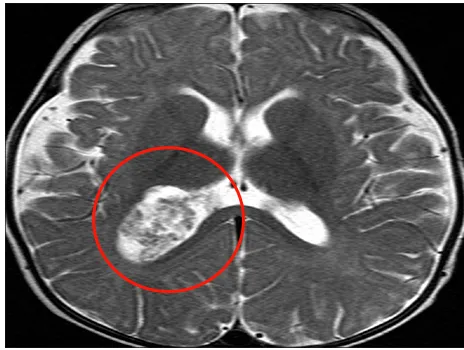 脉络丛乳头状瘤