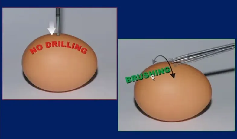 Dolenc教授术中操作形象图