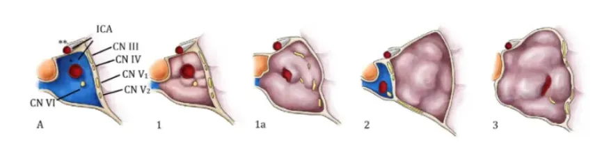 三种生长模式的海绵窦脑膜瘤