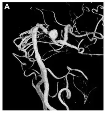 警惕！55 岁大叔头晕记忆力差，竟藏着两大致命风险：颈动脉堵了 + 动脉瘤要破