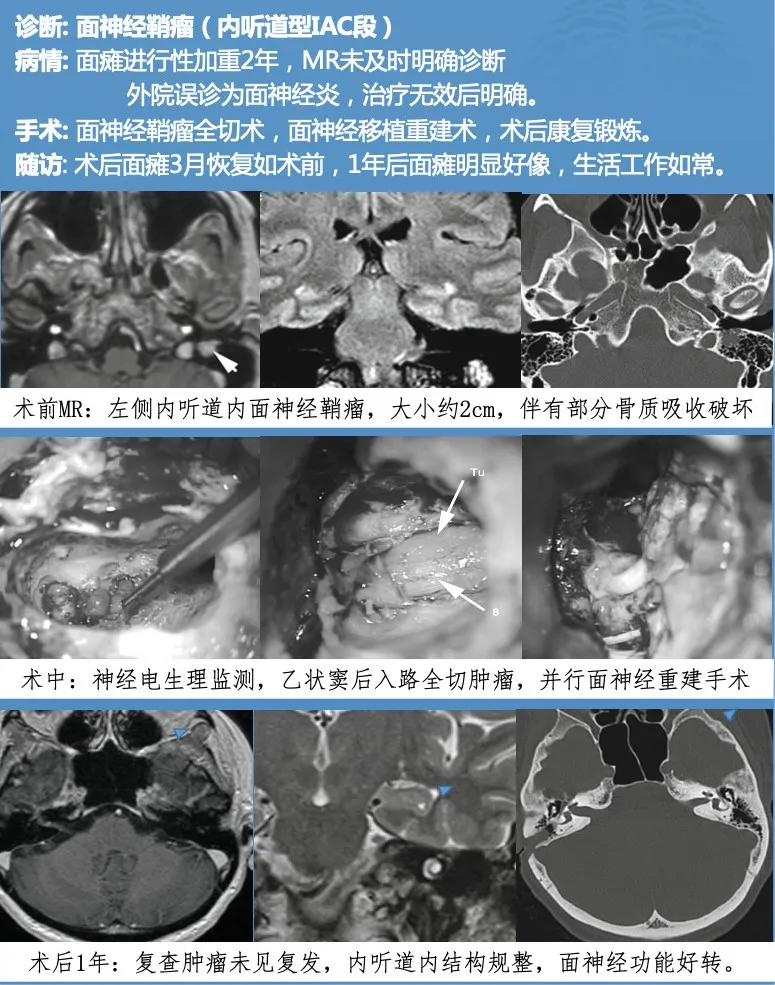 INC巴特朗菲教授案例分享