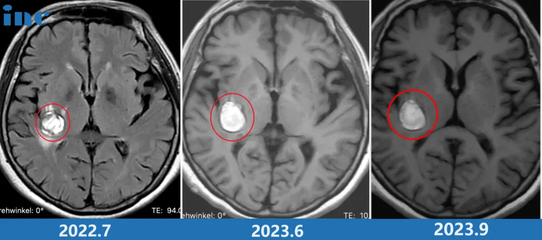 右侧基底节海绵状血管瘤