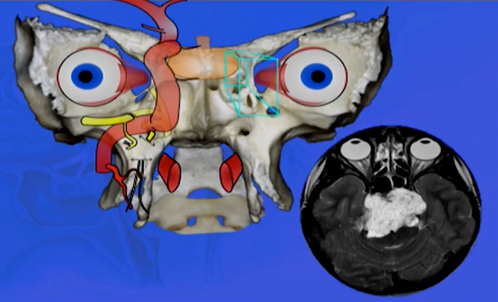 “易复发的脑瘤切了也白切？”她从癌症研究者变身患者，如何自救？