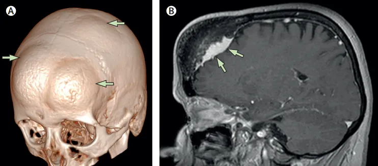58岁女子头上长了3个“角”？一查竟是多发脑瘤，先切哪个好啊？
