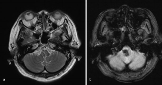 图：磁共振图像显示出血没有明显的病理原因，（a）T2加权（b）T2加权。