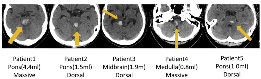 图：5例原发性脑干出血（PBH）患者的轴位CT影像。