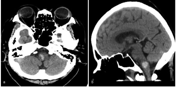 图：右侧延髓出血的电脑断层影像，（a）轴向（b）矢状面。