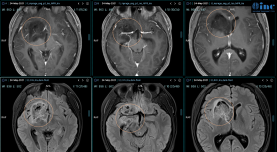 胶质瘤病理报告怎么看？2025更新版！