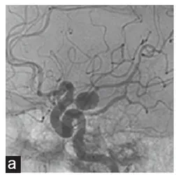 致命脑瘤两年疯长三倍，高龄手术如何破局？