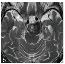 诊断2年3个月后磁共振成像显示动脉瘤内有血栓，直径达30mm，压迫脑干。