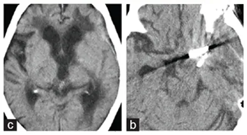 术后CT显示，脑干解除占位效应，无缺血性病变