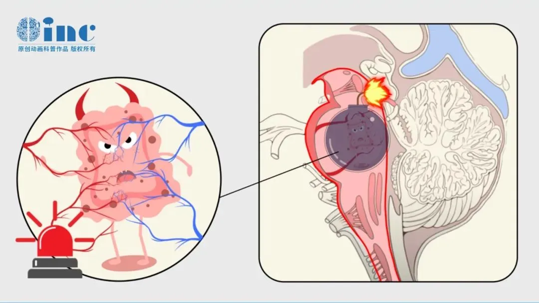儿童脑海绵状血管瘤