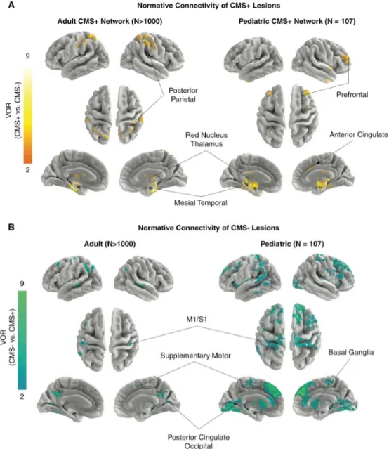 图2.CMS+病灶在成人与儿童中的连接模式