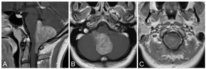 临床查体未见明显异常，无脑积水征象