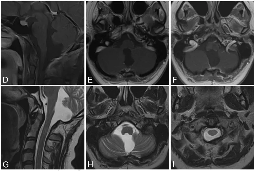 “室管膜瘤全切术后3年没复发，我距离‘治好’还有多远？”