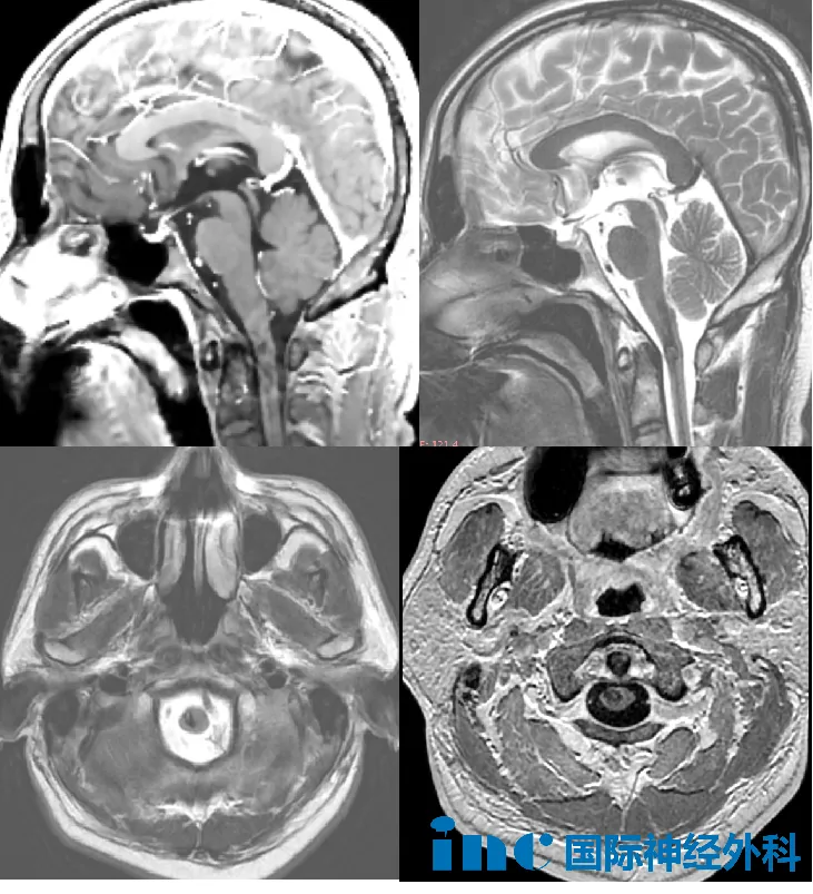 一场毫无预兆的后颈疼痛，让我想动不能动、想咽咽不下！