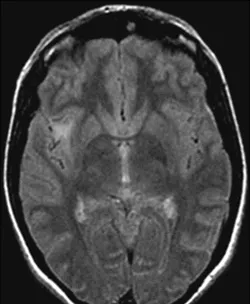 我的低级别胶质瘤术后为何变4级？原来恶化早有征兆，何时手术成关键！