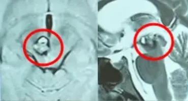 收到3次病危通知的她，在第4次脑干出血后却笑了：我要战胜它！