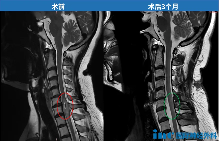 “治病的手术，为何有可能让我瘫痪？”整夜只能坐着睡觉的她，决定切掉脊髓肿瘤