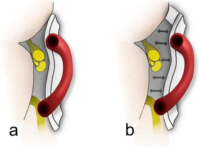 神经血管减压技术