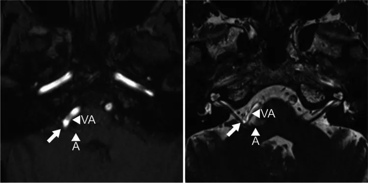 MRI发现小脑前下动脉与椎动脉明确压迫出脑干区的面神经